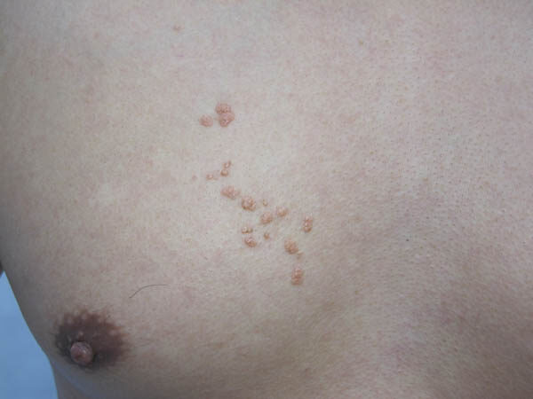 Sebaceous hyperplasia: soft yellowish papules of enlarged oil glands