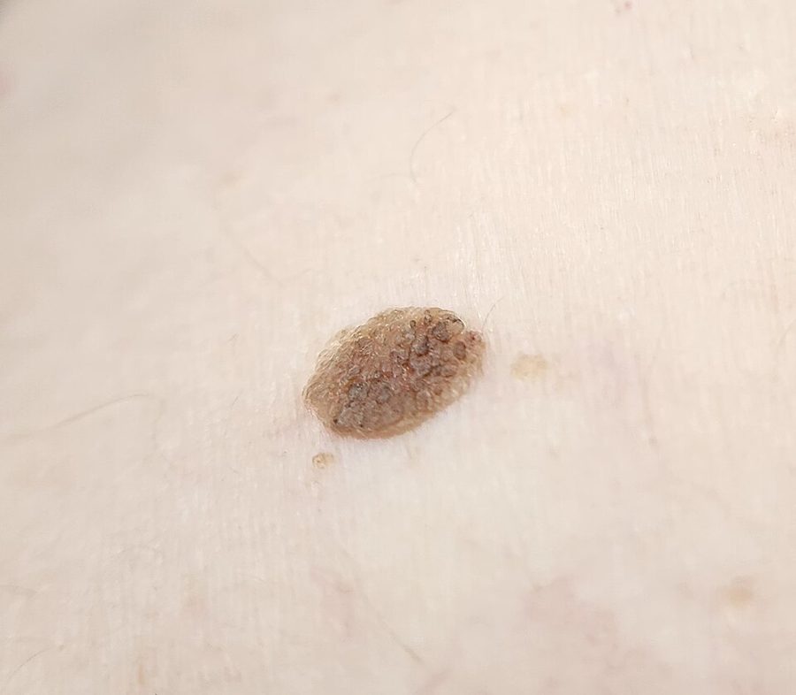 Close-up of a waxy, stuck-on keratosis