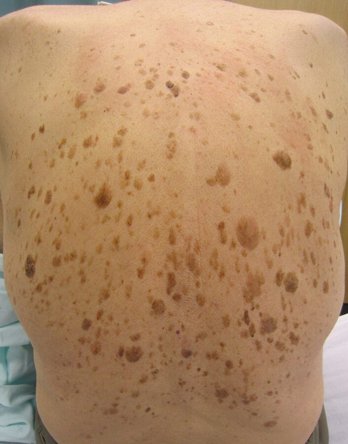 Multiple seborrhoeic keratoses — the 'stuck-on' age warts — across the back