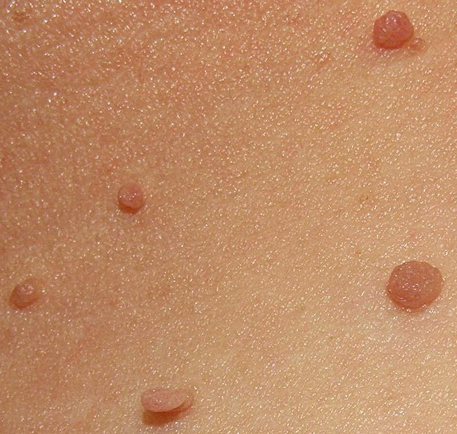 Multiple skin tags on the neck