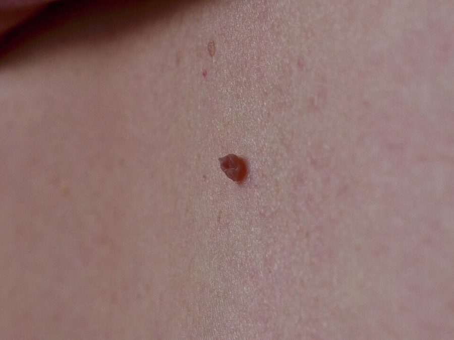 A solitary skin tag on the trunk