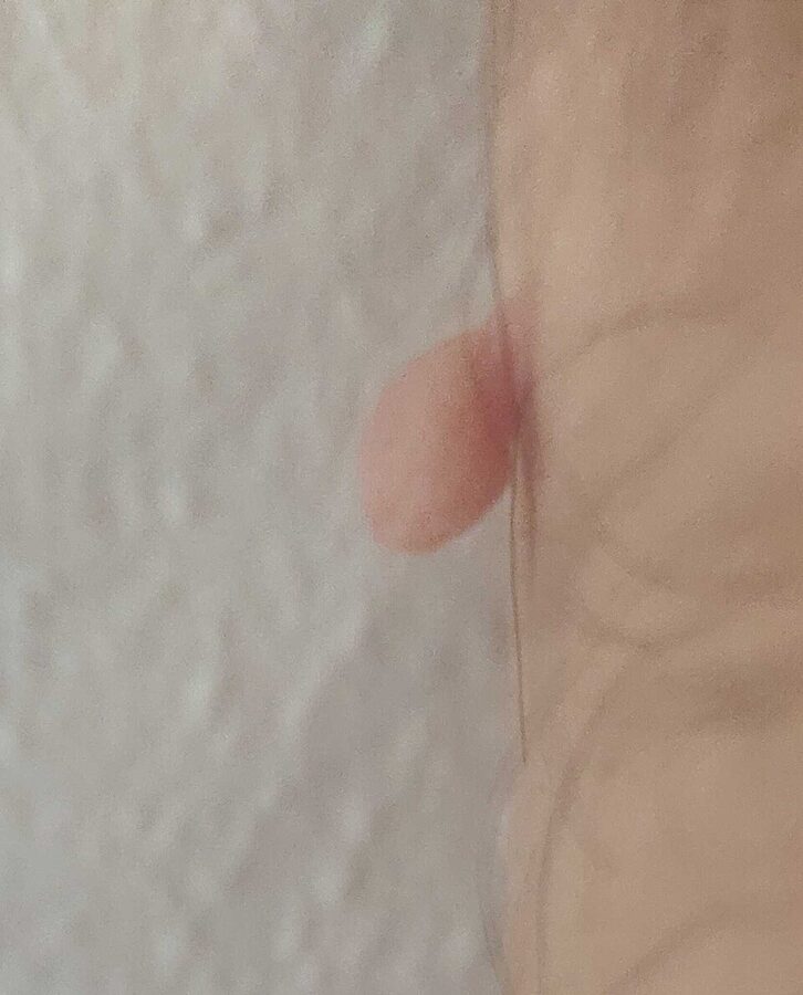 A soft pedunculated skin tag (acrochordon)