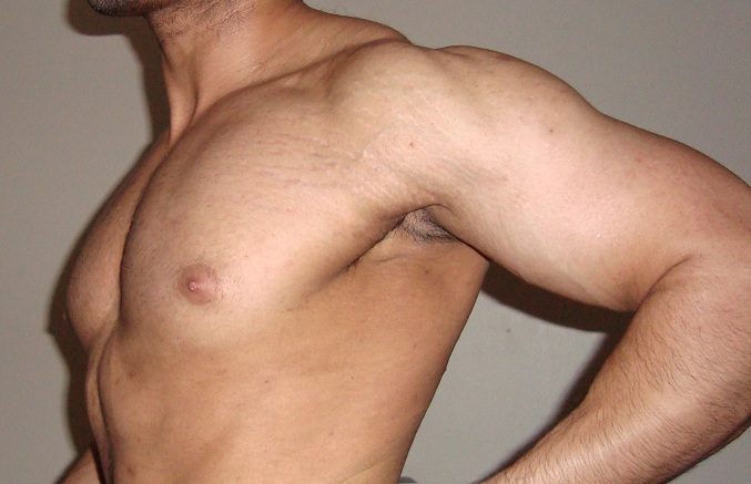Striae over the shoulder and chest in a male