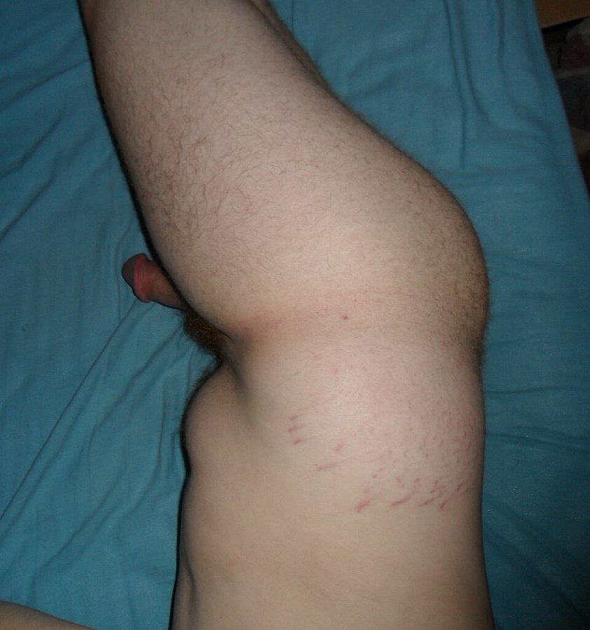 Striae over the hip and buttock