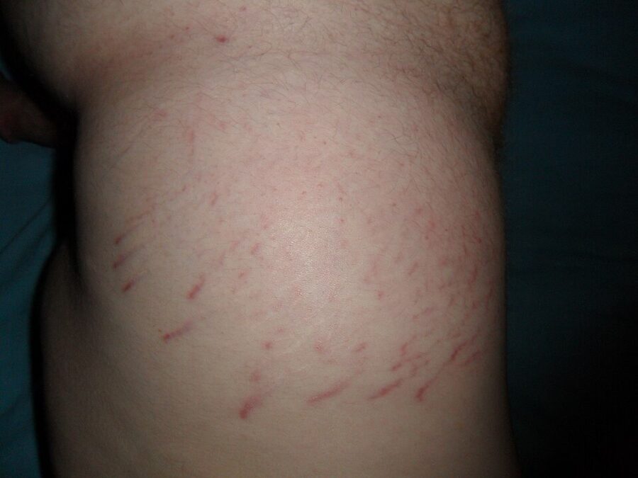 Early-stage red striae (striae rubrae) before they fade to white