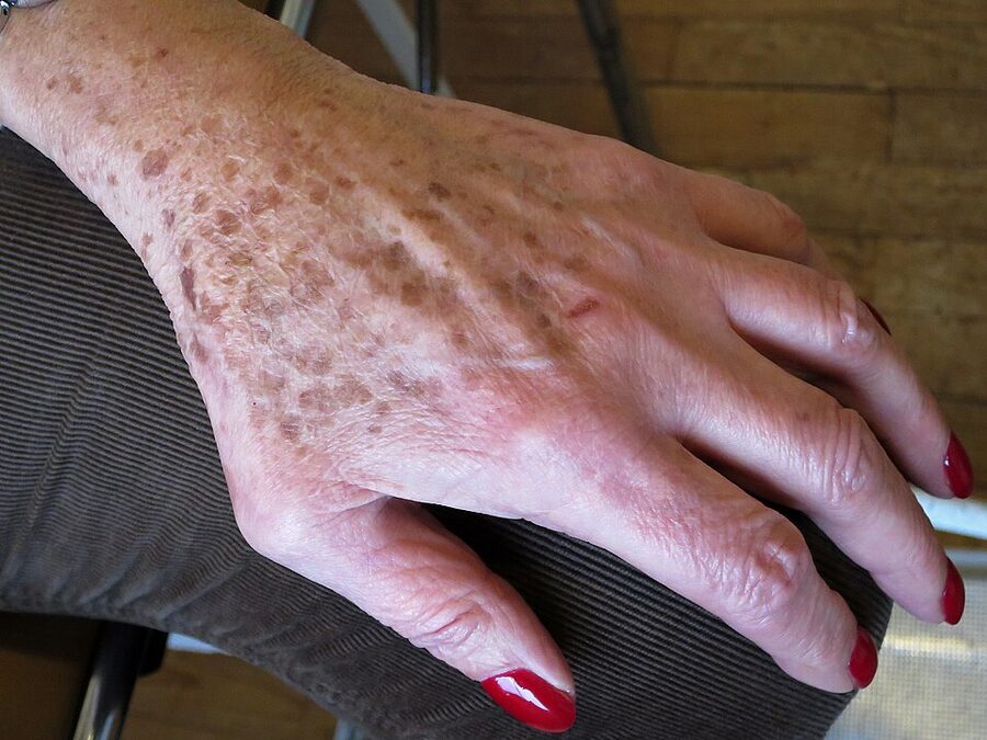Solar lentigines on the dorsal hand — flat brown sun spots on chronically exposed skin