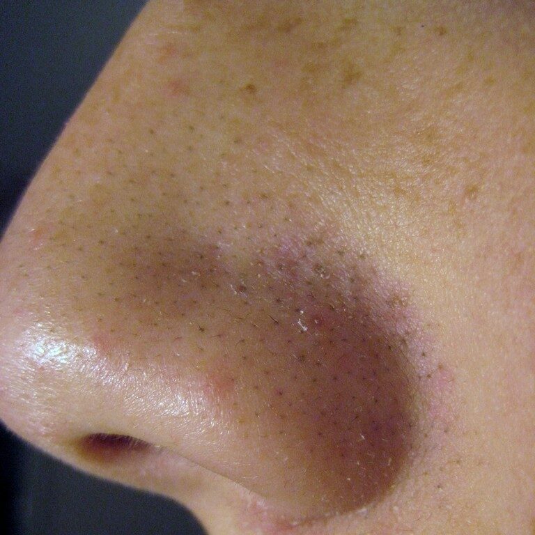 Enlarged, congested pores and blackheads over the nose