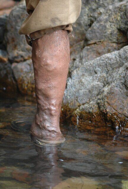 Severe varicose veins: rope-like, tortuous vessels of the calf