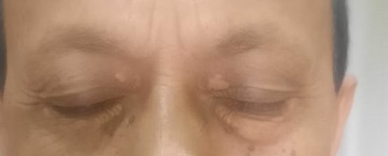 Yellowish plaques on both upper eyelids