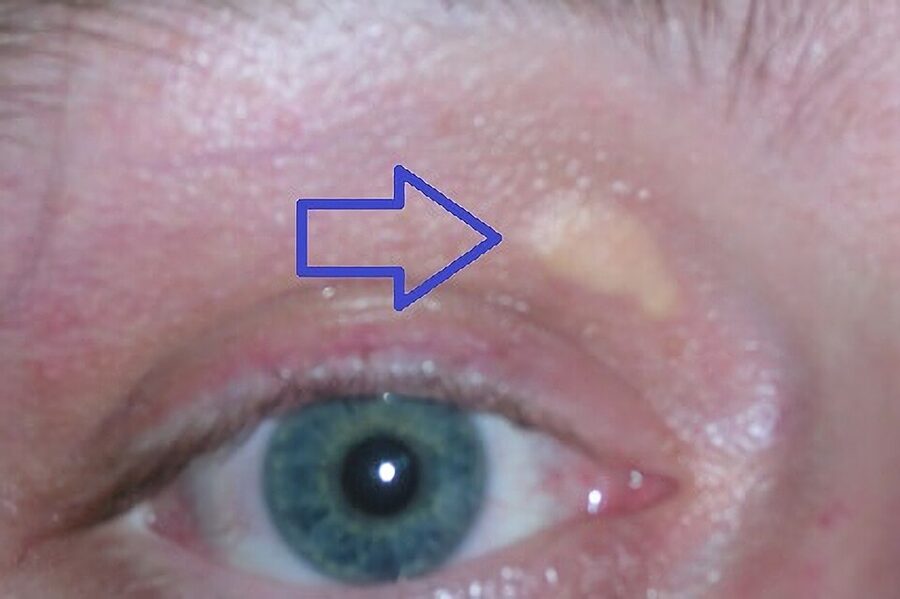 Xanthelasma: a soft yellow cholesterol plaque at the inner upper eyelid (arrow)