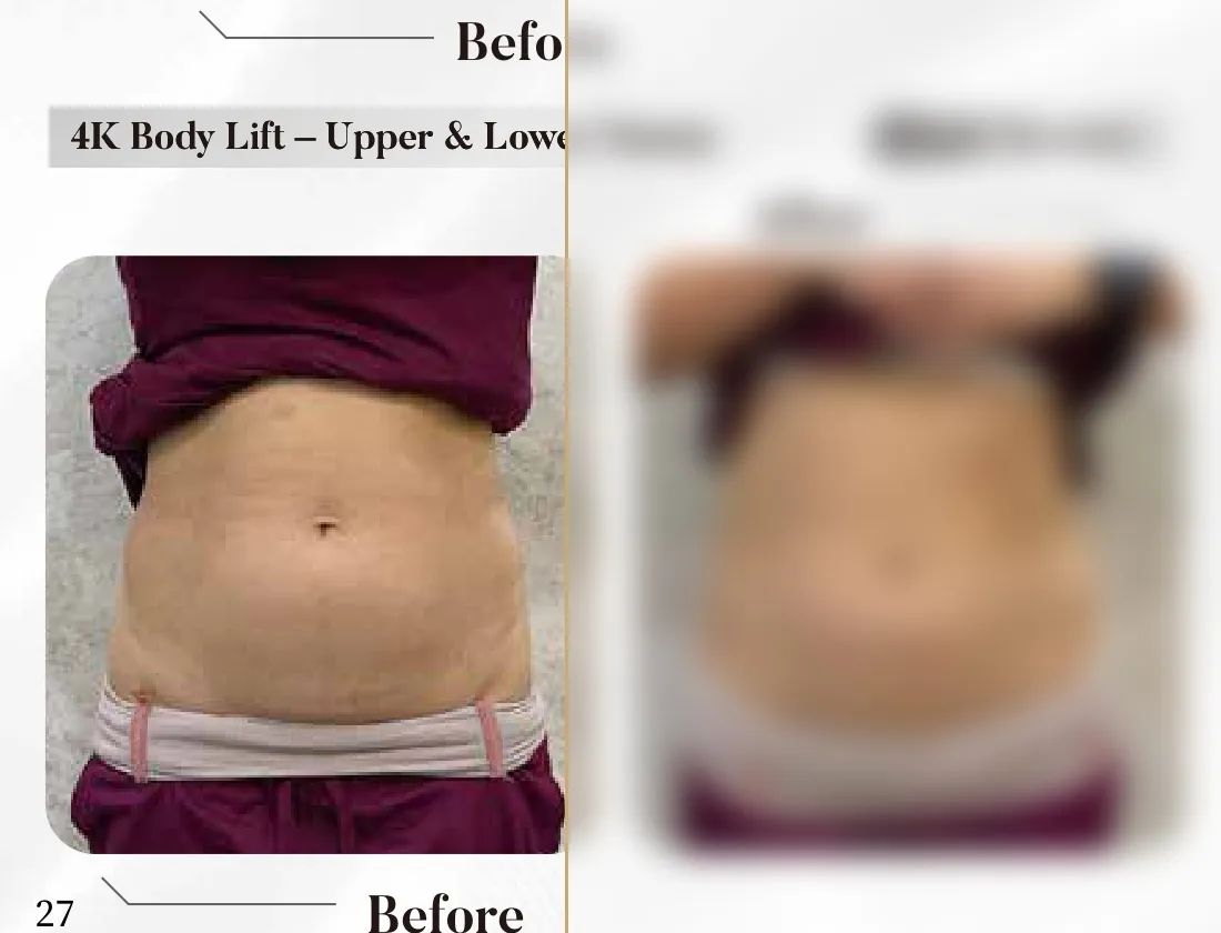 4K Body Lift — Upper & Lower Tummy (Single Session)