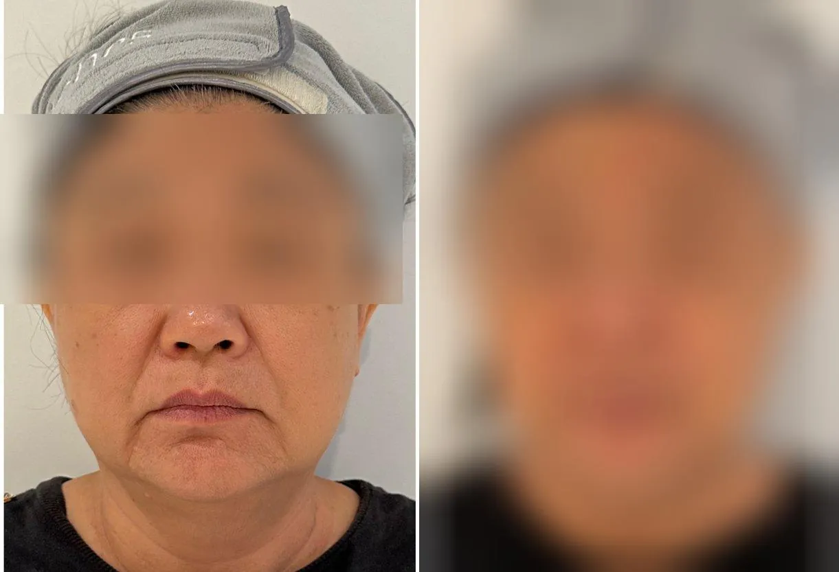 VF Facelift - Lifts Nasolabial Folds Jowls Double Chin