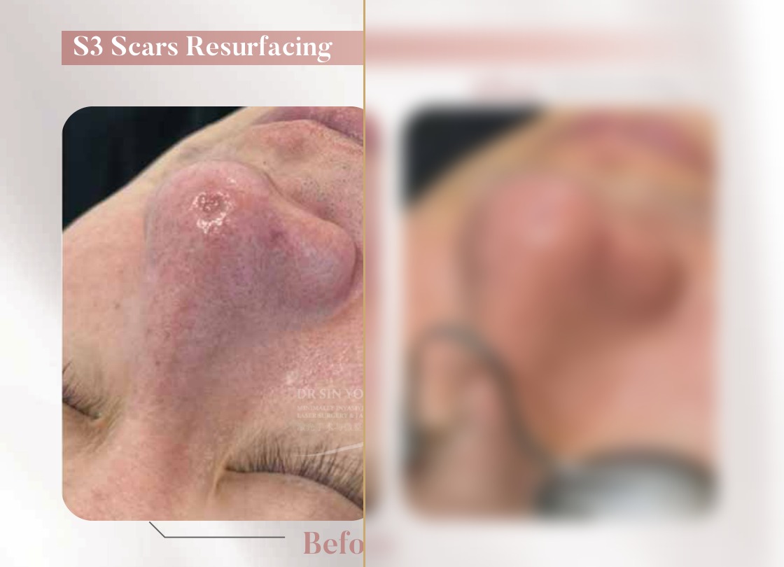 S3 Resurfacing Lift Laser — Scars Resurfacing
