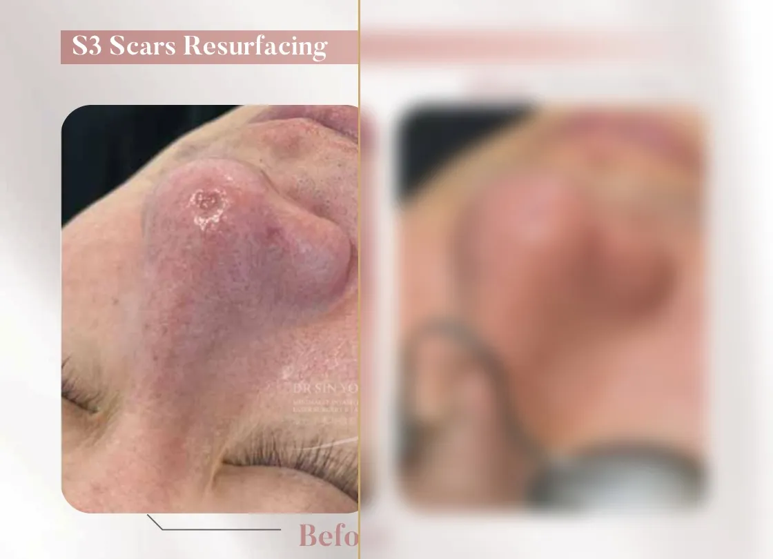 S3 Resurfacing Lift Laser — Scars Resurfacing