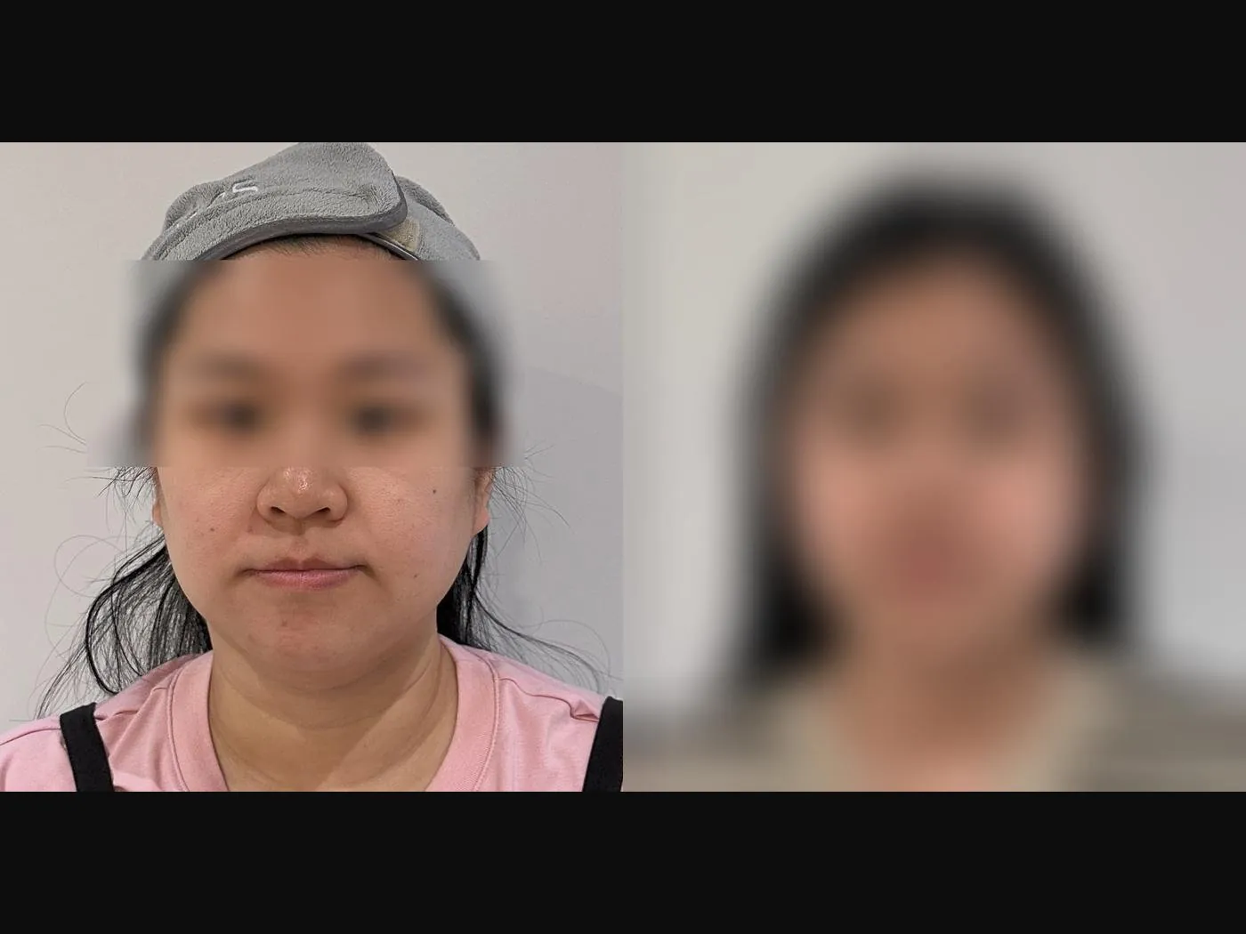 VF Facelift - Sculpts Excess Lower Face Volume