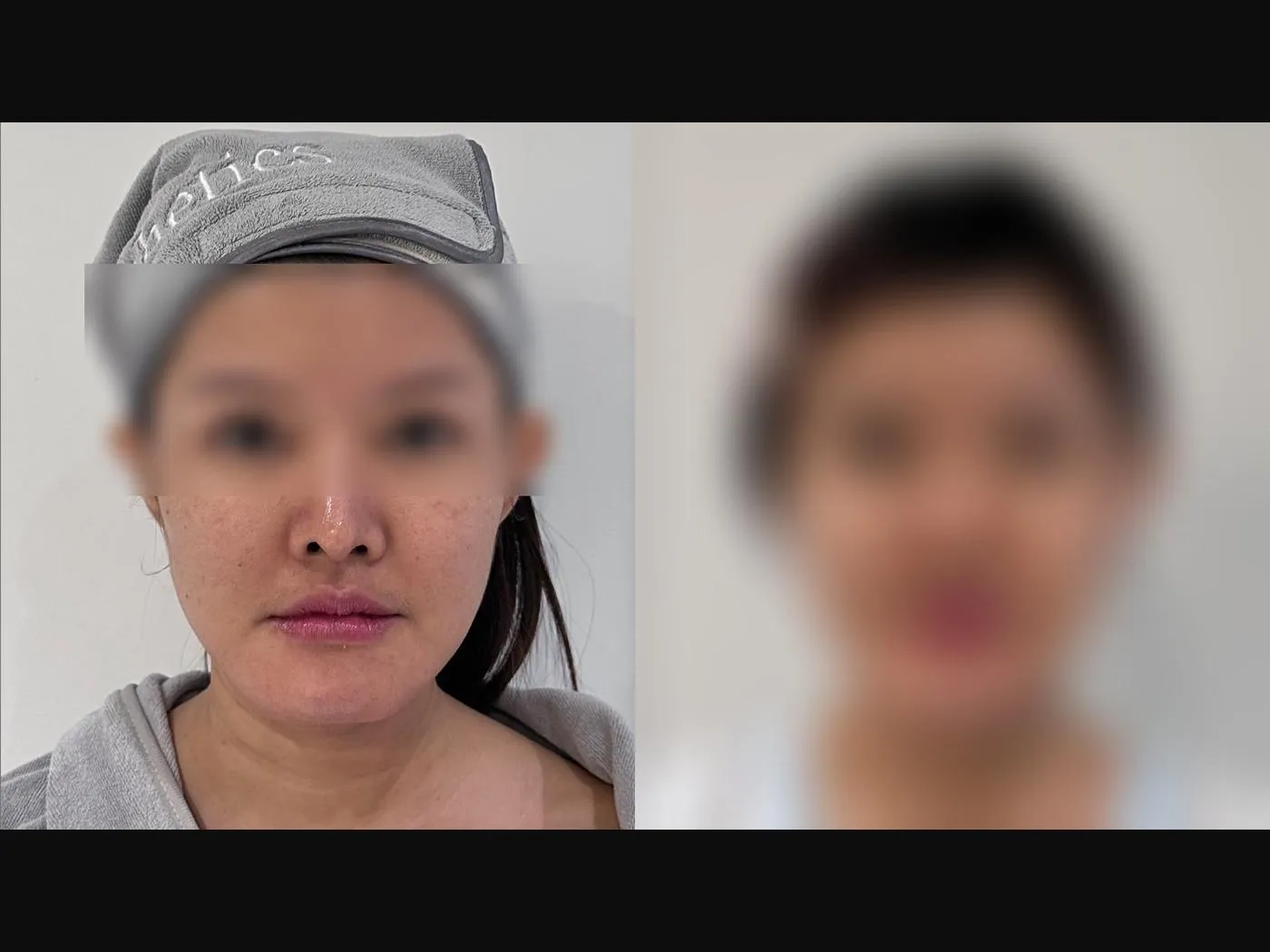 VF Facelift - Sharpens & Lifts Lower Face 7