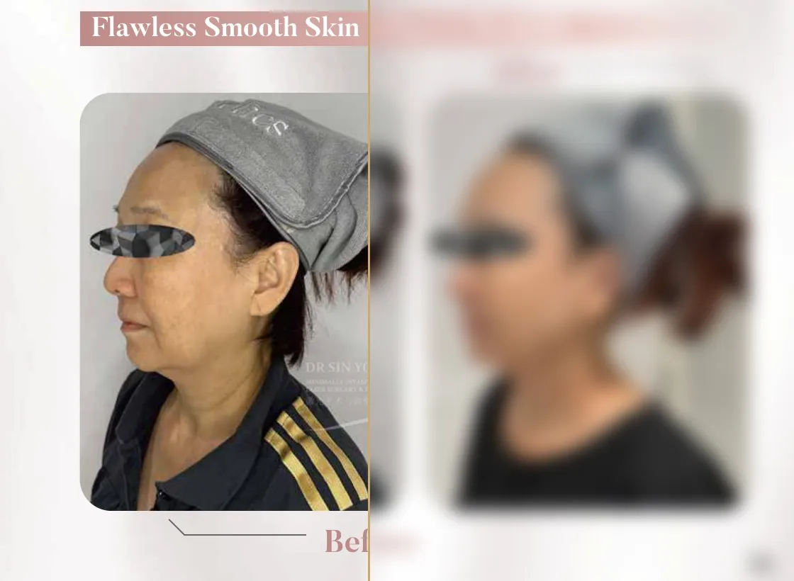 FSX Laser — Face & Necklift