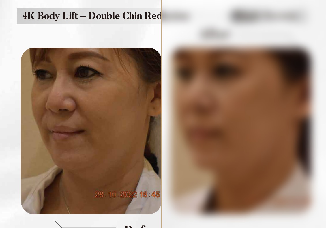 4K Body Lift — Double Chin Reduction (Single Session)