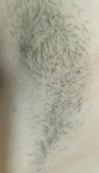 Dense axillary underarm hair before alexandrite laser hair removal