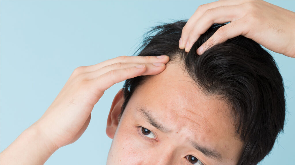 Hair Loss Treatment methods in Singapore