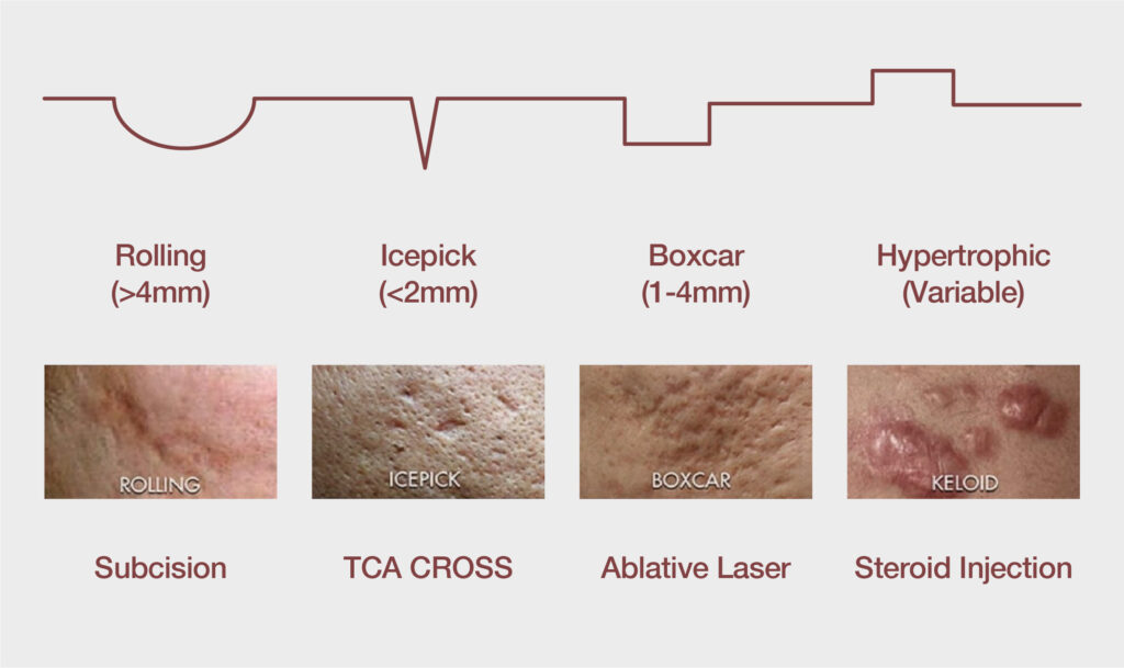 Scar Reconstruction: Treating Skin Scars