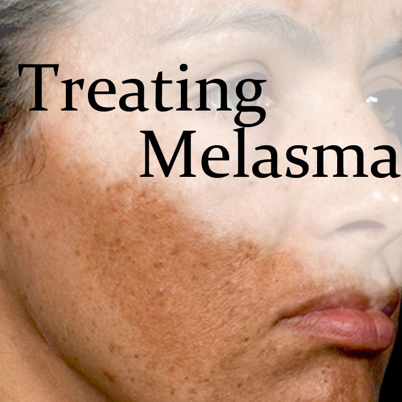 Melasma Treatment - laser treatment for skincare | Dr Sin Yong