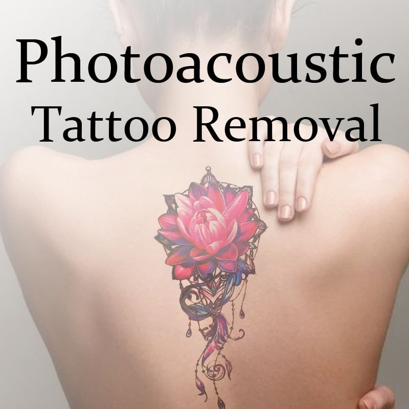 Photoacoustic Tattoo Removal | Photoacoustic Laser Treatment