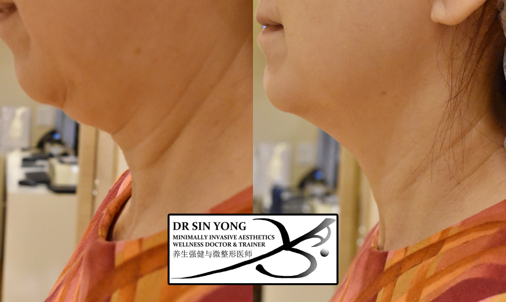 time freeze laser double chin reduction and neck lines