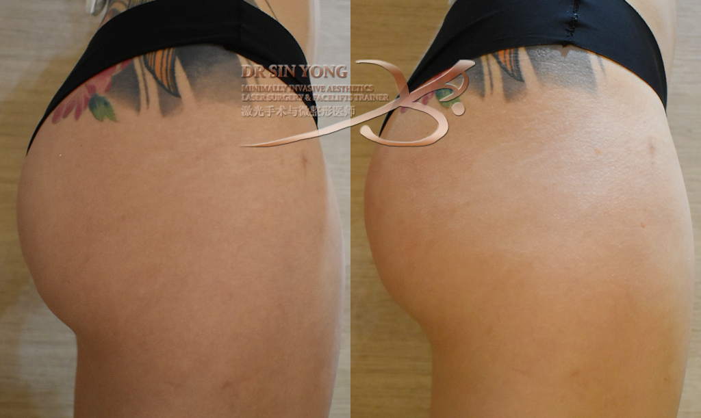 Cellulite Redefined Treatment | Cellulite Thighs, Buttock, Abdomen