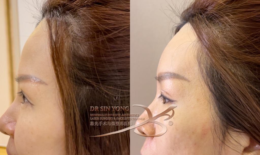 Forehead Filler | Radiesse Advanced Dermal Filler